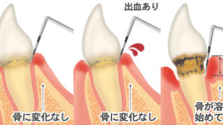 歯周病の進行 | 歯医者・横浜旭区でインプラント、歯周病、根管治療に 